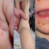 Tìm hiểu bệnh chân tay miệng ở trẻ nhỏ