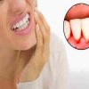 Nguyên nhân và cách chữa chảy máu chân răng tại nhà