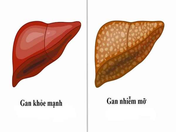 Nguyên nhân, biểu hiện và các biến chứng nghiêm trọng của gan nhiễm mỡ