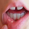 Nhiệt miệng là gì - Cách khắc phục bệnh nhiệt miệng