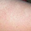 Nguyên nhân, biến chứng và cách phòng tránh viêm nang lông